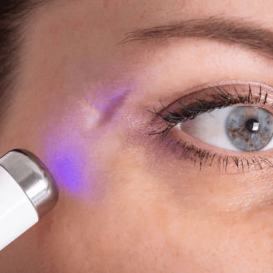Narben behandeln mit Laser