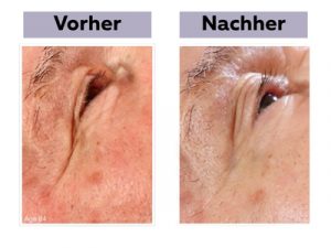 Jetpeel-Ergebnisse am Auge