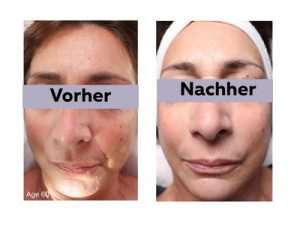 Ergbenisse einer Jetpee-Behandlung im Gesicht