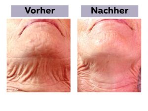 Ergebnisse einer Jetpeel-Behandlung am Hals
