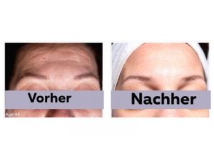 Ergebnis einer Jetpeel-Behandlung an der Stirn