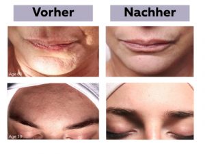 JetPeel Ergebnisse an Lippen und am Kinn
